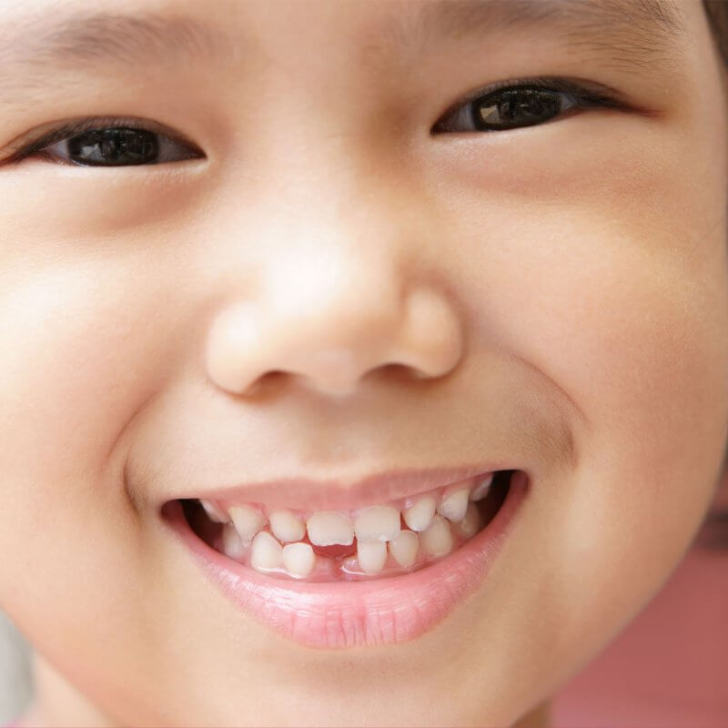 Child with a Chipped Tooth that can be treated by pediatric dentists at Pediatric Smiles of Orem