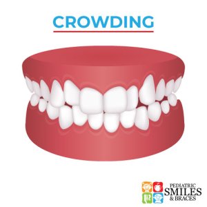 Pediatric Smiles graphic depicting dental crowding