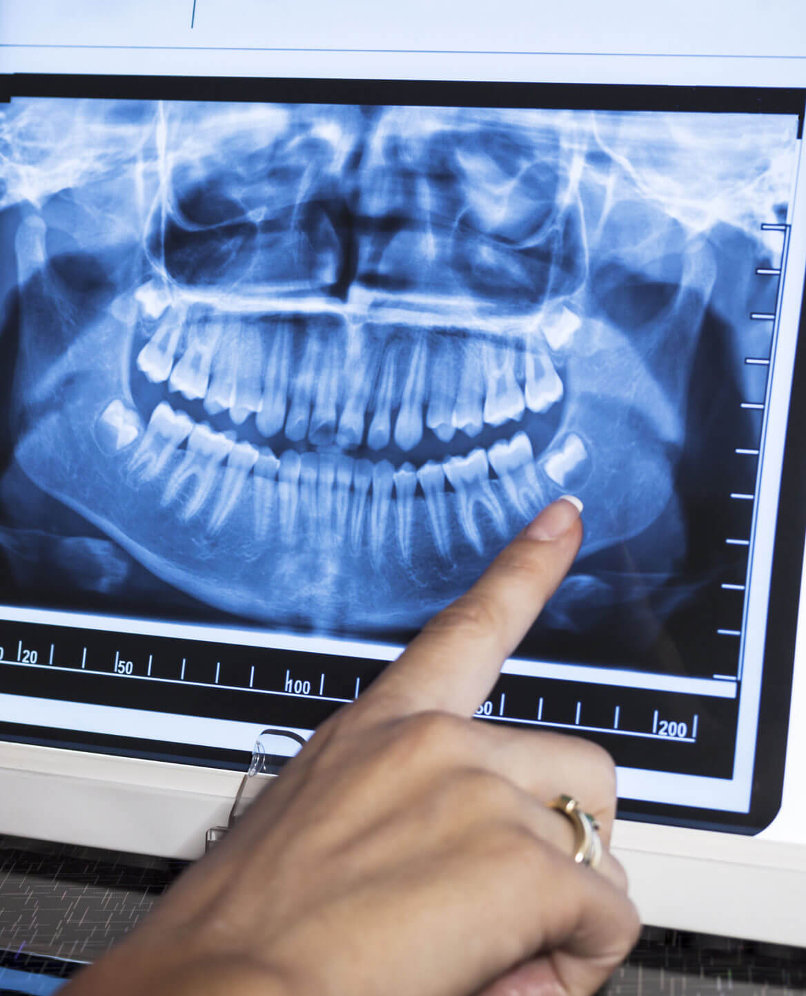 Advanced Pediatric Dentist Dental X-Ray: Precise Imaging for Children's Oral Health